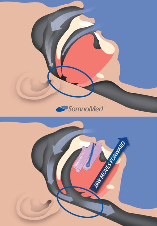 Apnea Infographic